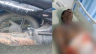 Acid splashes from lorry; motorcyclist suffers severe burns in Kochi