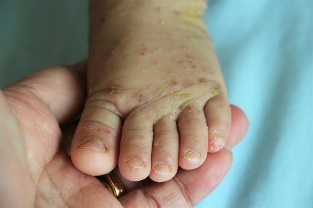 Medieval skin disease leaving patients’ flesh ‘crawling’ surges through the UK