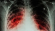 Dr. Arnaiz: "Así es la estrategia oral contra la tuberculosis resistente"