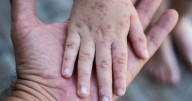 Sarampión avanza en México: 25 estados con contagios, 22 muertes y casi 5 mil casos; solo 6 estados libres de la enfermedad