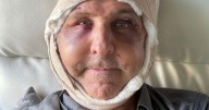 Biohacker got 'facial circumcision' in bid to get younger but regrets one thing