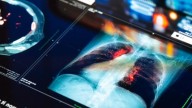 Why Lung Screening Matters