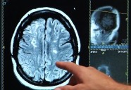 Los avances en el tratamiento de los ictus permiten extraer el 90% de los trombos