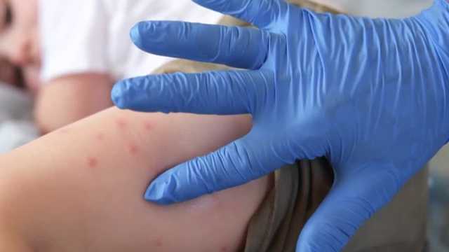 Measles outbreak in SC raises concerns over vaccination rates