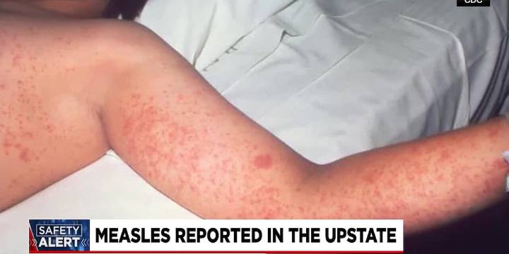 New measles cases confirmed in Spartanburg County outbreak