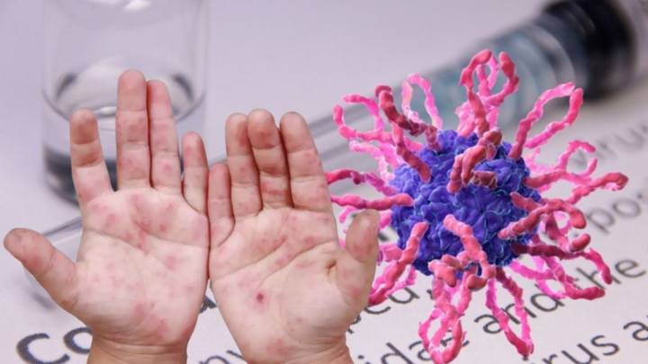 Virus Coxsackie contagió a 17 niños en escuela de Puebla; ¿cuál es su estado de salud?