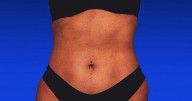 RibXcar ‘Rib Remodeling’ Surgery Review: Before and After