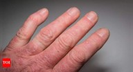 What is Psoriatic Arthritis: Know its signs, causes, and how to manage