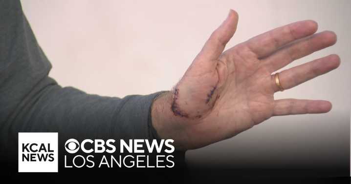 Swimmer talks about shark attack off Catalina Island coast