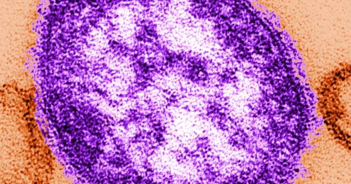 BREAKING NEWS: Alberta baby dies from measles, marking second Canadian death from disease in 2025