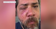 "This is unacceptable": Lafayette man recovering after random attack during walk home