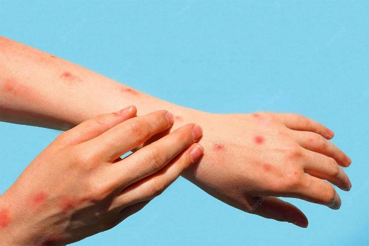 Bhopal News: Schools Warn Parents Of 'Tomato Virus' As Kids Fall Sick