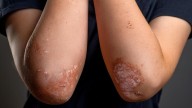 FDA Approves Tremfya for Pediatric Plaque Psoriasis, Active Psoriatic Arthritis