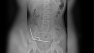 13-year-old boy hospitalized after swallowing dozens of high-powered magnets, New Zealand Medical Journal says