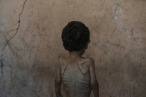 ONU: Casi 55.000 niños en Gaza menores de 5 años podrían estar agudamente desnutridos