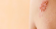 Shingles Vax Protects Against Heart Disease, Dementia, Death