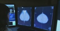New breast cancer treatment trial at UCSF aims to avoid invasive surgery for patients