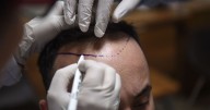 How one country has become a top destination for hair transplants
