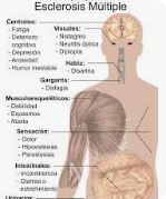 Detectan señales tempranas de daño cerebral años antes de la Esclerosis Múltiple