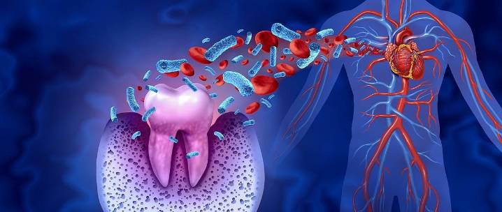 Periodontal Disease, Caries Linked to Risk for Ischemic Stroke, MACE