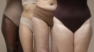 Cómo saber si tienes lipedema o linfedema: síntomas, diagnóstico y opciones de tratamiento