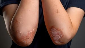 FDA Approves Tremfya for Pediatric Plaque Psoriasis, Active Psoriatic Arthritis