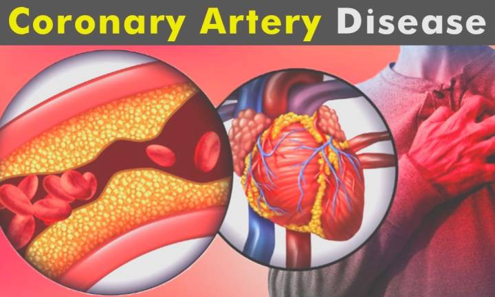 Cutting Balloon Angioplasty Before Stenting Found Comparable to Intravascular Lithotripsy in...