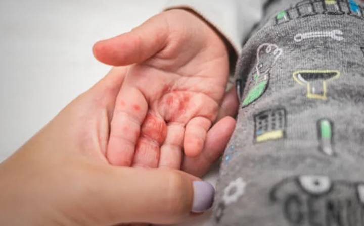 Suspenden clases tras brote de virus Coxsackie en escuela de Izúcar de Matamoros, Puebla