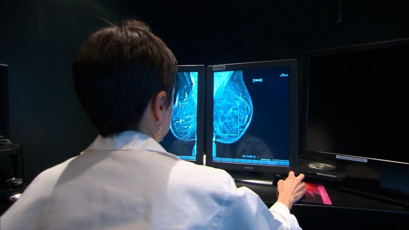 Este tipo de cáncer de mama es poco conocido pero va en aumento en EE.UU.