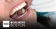 Having gum disease and cavities is linked with higher risk of stroke, studies find