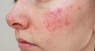 Piel sensible: 5 errores que podrías estar cometiendo sin saberlo, y cómo corregirlos