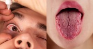 ¿Ojos y boca seca? Así afecta el síndrome de Sjögren según la UNAM