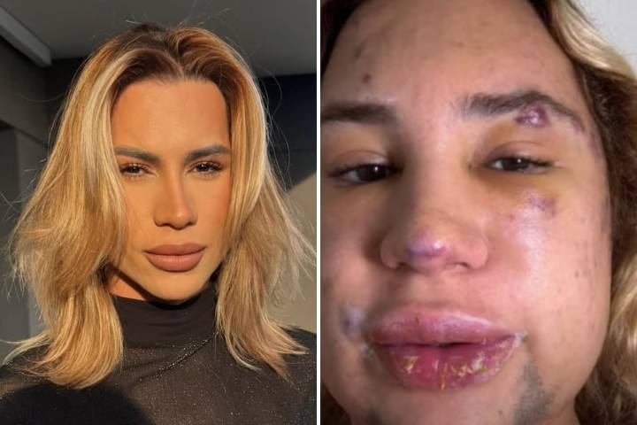 Procedimiento "foxy eyes". Un influencer brasileño de 31 años murió tras una cirugía estética que le hizo un dentista