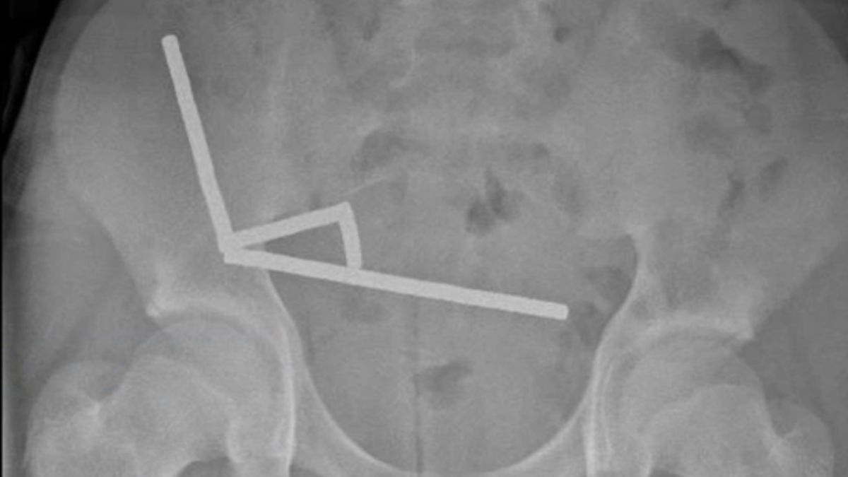 New Zealand Teen Loses Part of His Bowel After Swallowing Nearly 200 Magnets