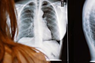 Al año hay cerca de 300 casos confirmados de tuberculosis, en Baja California Sur 