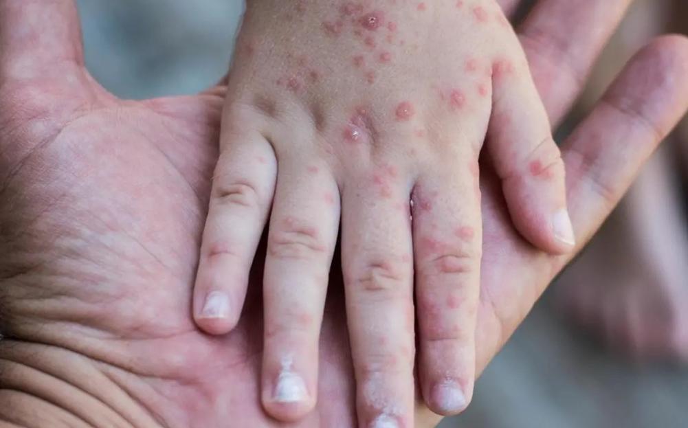 Saltillo: Secretaría de Salud dictaminará posible brote de coxsackie en el Colegio Nicolás Bravo