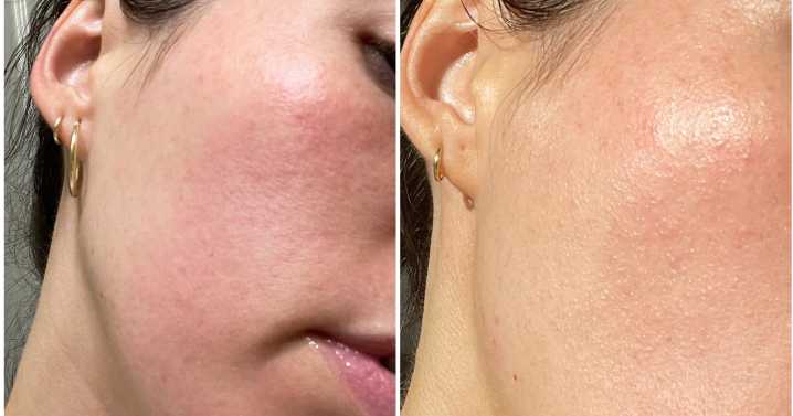 What Is Contact Dermatitis? Skin Tips From a Dermatologist