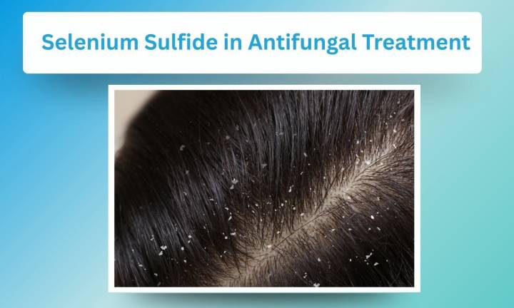 Advancements in Antifungal Treatment: Insights from In vitro Trials with Selenium Sulfide