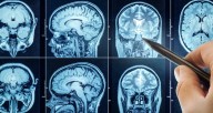 Cerebro de los hombres se encoge más rápido que el de las mujeres, revela un estudio