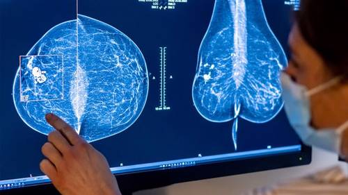 New 1-day surgery removes cancer and reconstructs the breast in the same operation