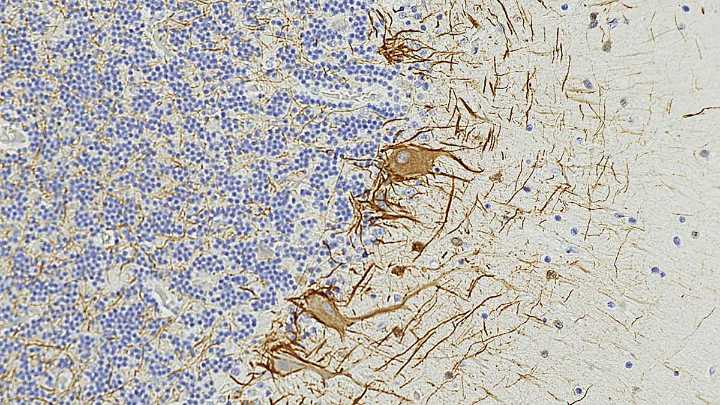 Blood Signals May Predict Multiple Sclerosis 7 Years Before Symptoms