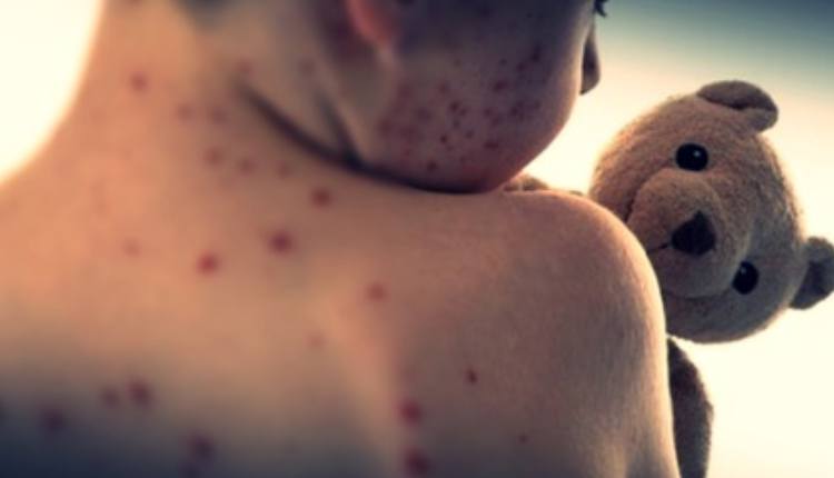 Australia: Measles Alert Issued For Northern Sydney