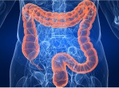 El segundo tipo más común. La Anmat autorizó una nueva terapia oral para pacientes con cáncer colorrectal avanzado