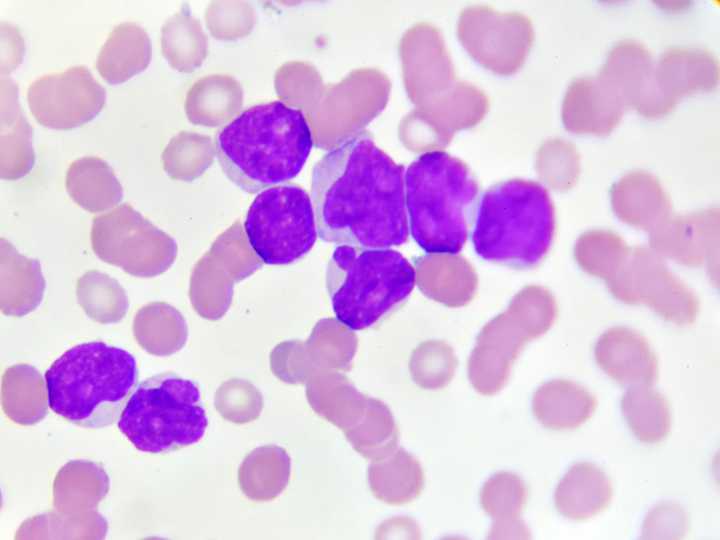 Combination Therapy Disables Resistance in Acute Myeloid Leukemia