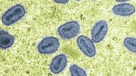 California officials confirm 1st US case of severe mpox strain with no travel history