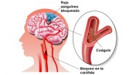 "Los avances para ictus permiten extraer el 90% de los trombos"