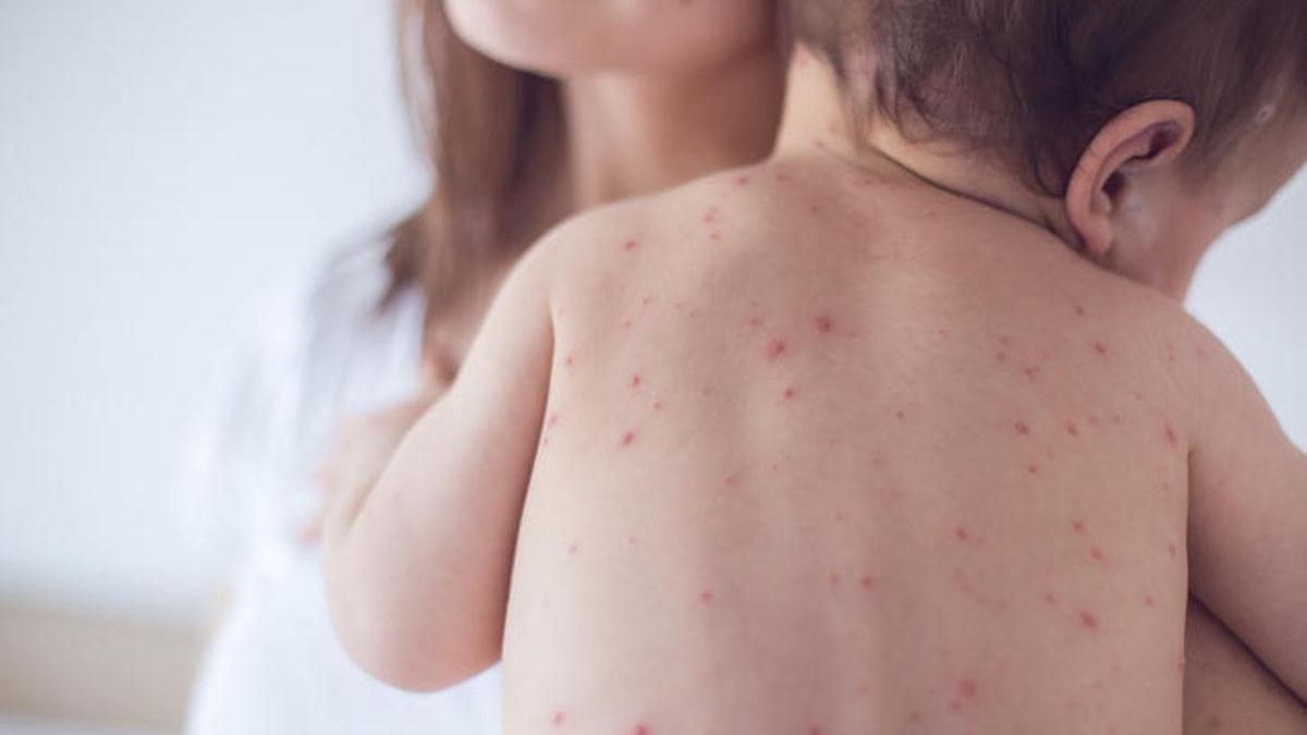 Tres personas, entre ellas dos bebés y una trabajadora sanitaria, presentan síntomas leves tras confirmarse un brote de sarampión en La Palma