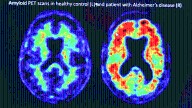 South Carolina struggles with neurologist shortage, rising dementia
