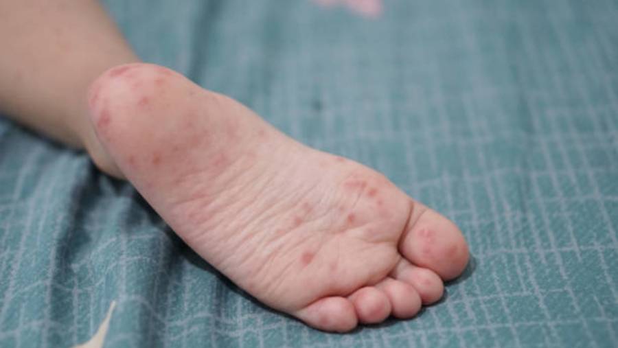 Detectan tres casos de virus Coxsackie en escuelas de Puebla