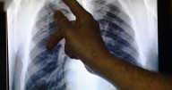 2 people with tuberculosis identified in Manchester, Nashua